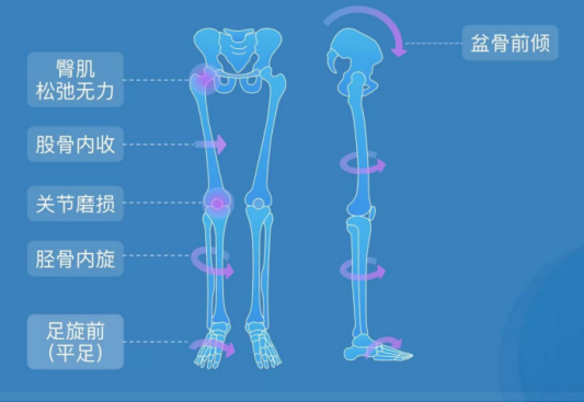 扁平足_副本.png