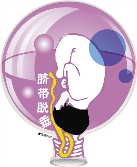 一产妇突发脐带脱垂，三科室联手开展抢救