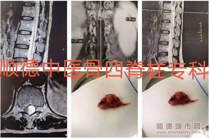 他的苦口婆心，让肿瘤病人获得了再次站起来的机会