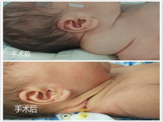 新生儿患淋巴囊性瘤，医生齐齐联合诊治