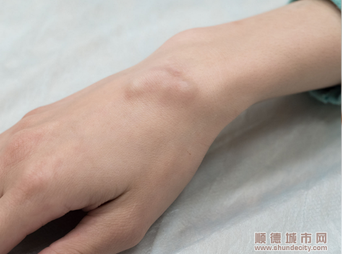 手腕鼓起“小包”？这个病症千万不要轻视。.png