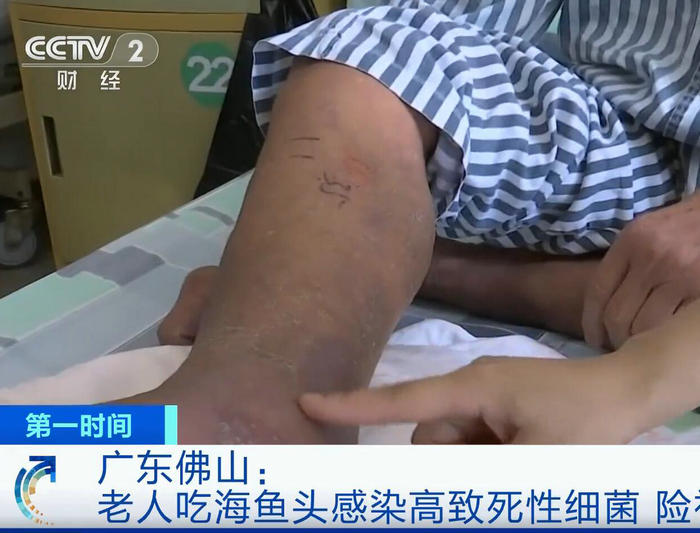 央视财经关注顺德三院医治病例，患者险被截肢
